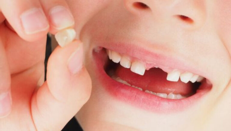 Sonhar com dente caindo